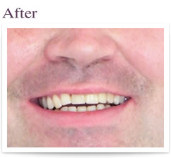 dental implants