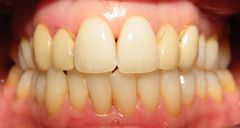 veneers downpatrick